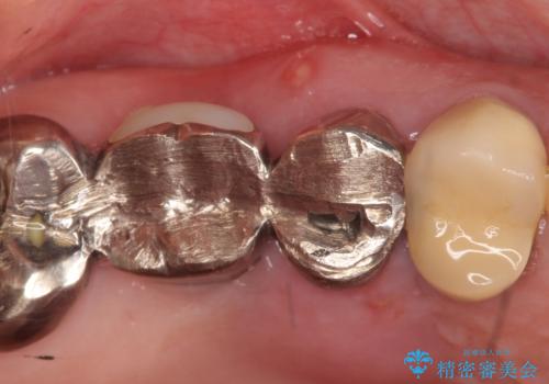インプラント(ストローマン)　抜歯後の欠損補綴の症例 治療前