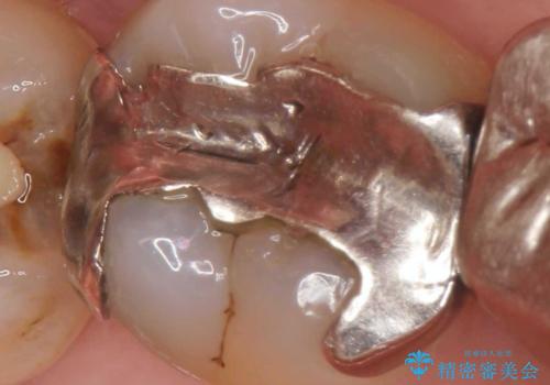 [銀歯の下の虫歯 ] 根管治療を伴う虫歯治療の症例 治療前