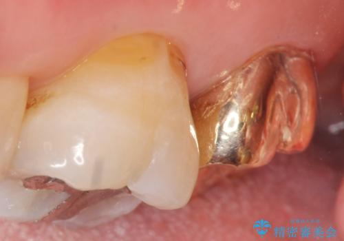 歯周外科で整備する安定したクラウン環境の治療後