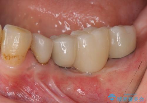 インプラントで咬合機能を取り戻すの症例 治療後