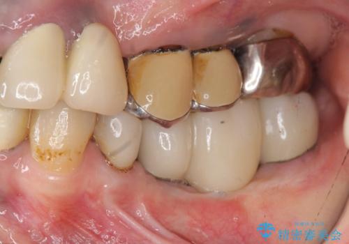 インプラントで咬合機能を取り戻すの治療後