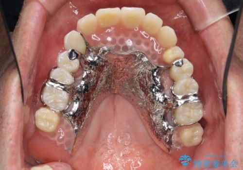 [インプラントオーバーデンチャー] インプラントで奥歯を支える部分床義歯の症例 治療後