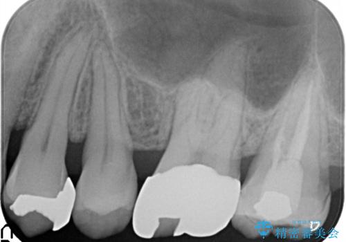 目立つ金歯を自然な色のオールセラミックへの治療前