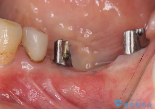 インプラントで咬合機能を取り戻すの治療中