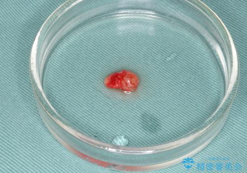 唇を噛んでしまった 粘液嚢胞の摘出の治療中