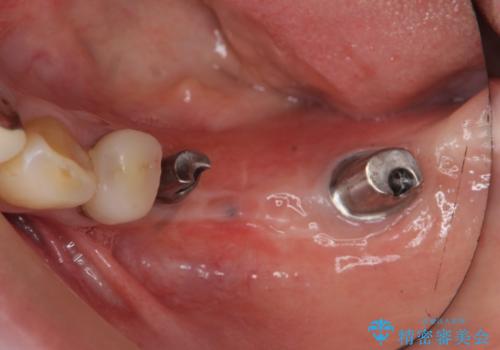 インプラントで咬合機能を取り戻すの治療中