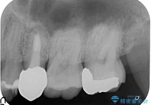 根管治療からのセラミック治療の治療後