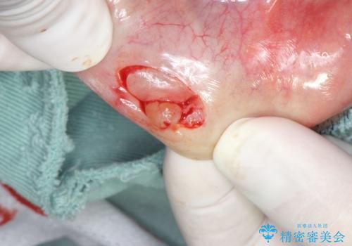 唇を噛んでしまった 粘液嚢胞の摘出の治療中