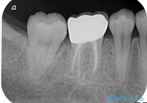 奥歯が痛い。根管治療~オールセラミッククラウンの治療後