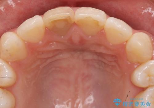 前歯の変色 セラミックで ホワイトニングも併用の治療前