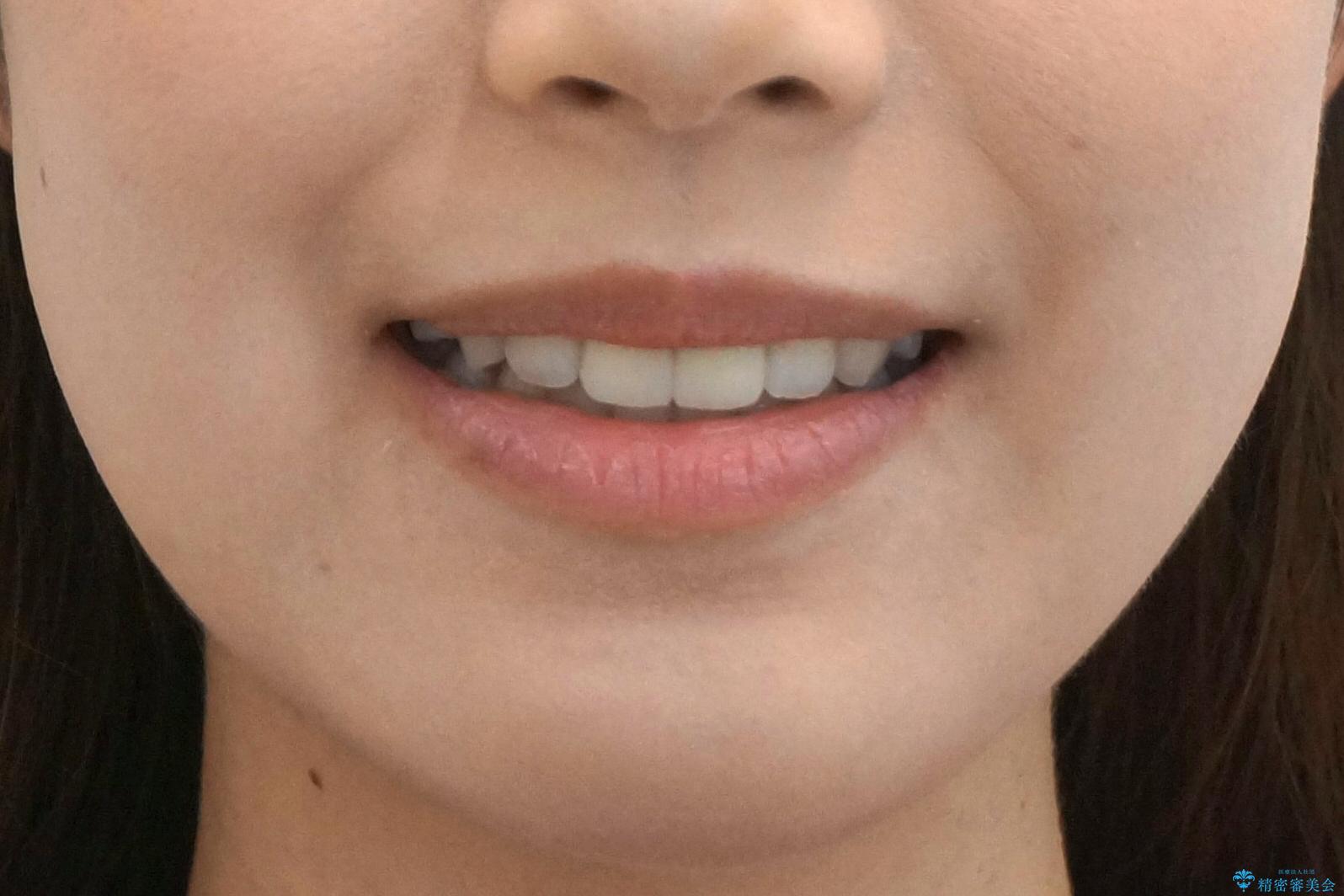 前歯の変色　セラミックで　ホワイトニングも併用の治療後（顔貌）
