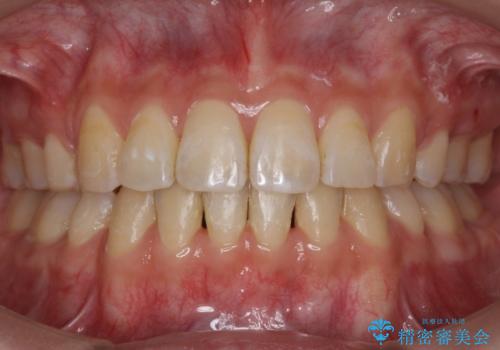 再矯正 一度抜かないでやったが、やっぱり抜いて口元下げたいの症例 治療後