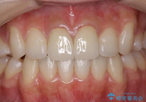 前歯の変色　セラミックで　ホワイトニングも併用の治療後