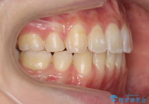 再矯正 一度抜かないでやったが、やっぱり抜いて口元下げたいの治療後