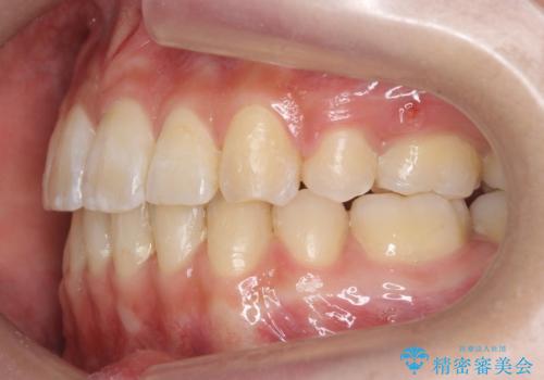 再矯正 一度抜かないでやったが、やっぱり抜いて口元下げたいの治療後