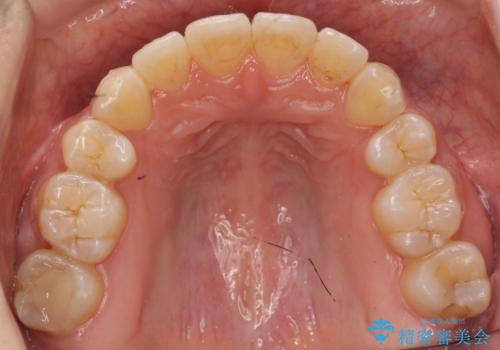 再矯正 一度抜かないでやったが、やっぱり抜いて口元下げたいの治療後