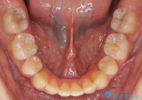 再矯正 一度抜かないでやったが、やっぱり抜いて口元下げたいの治療後