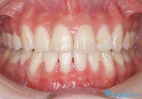 八重歯の治療　仕上がり重視での症例 治療後
