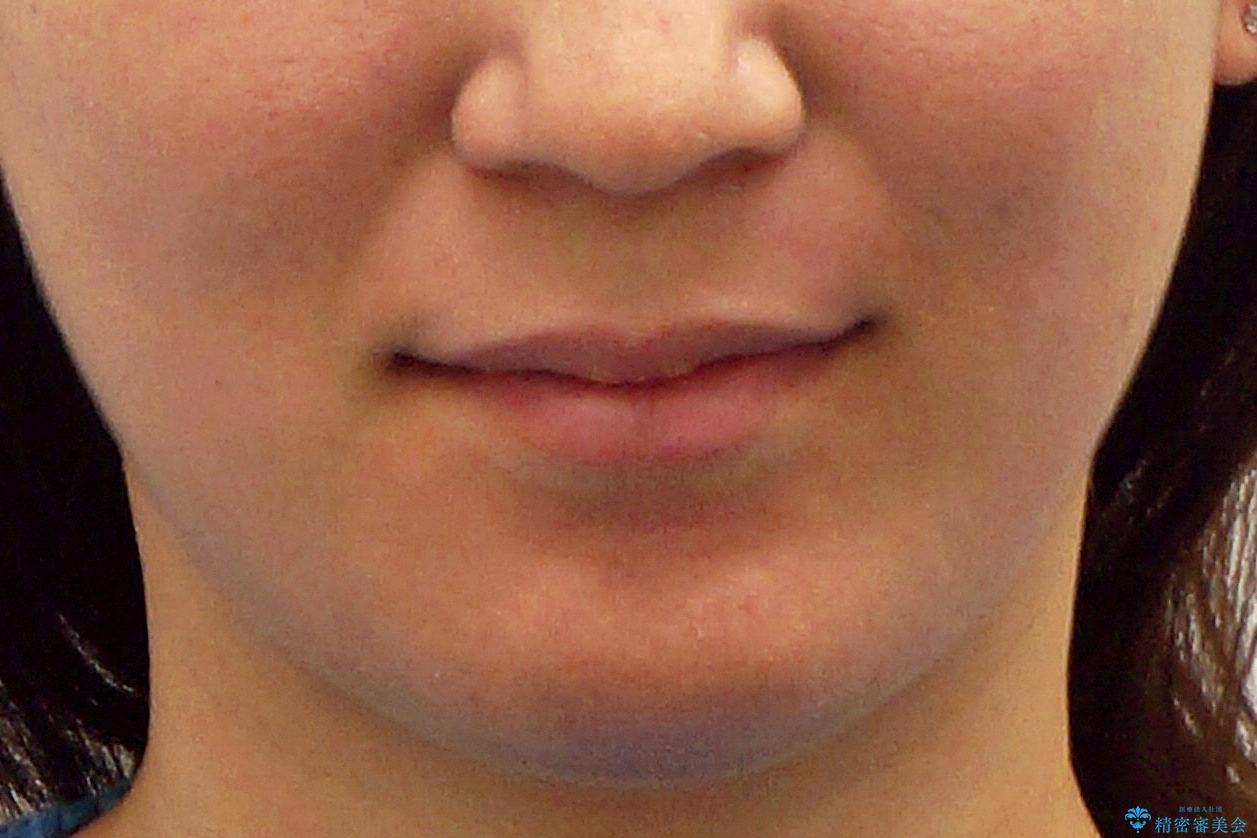 再矯正 一度抜かないでやったが、やっぱり抜いて口元下げたいの治療後(顔貌)