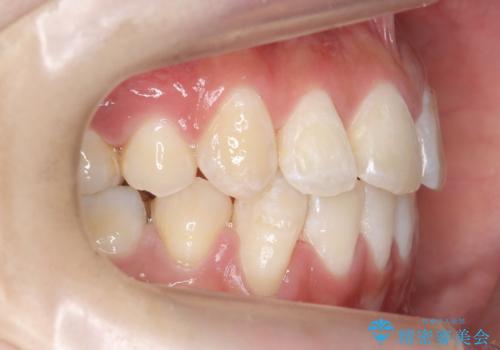 八重歯の治療 仕上がり重視での治療後