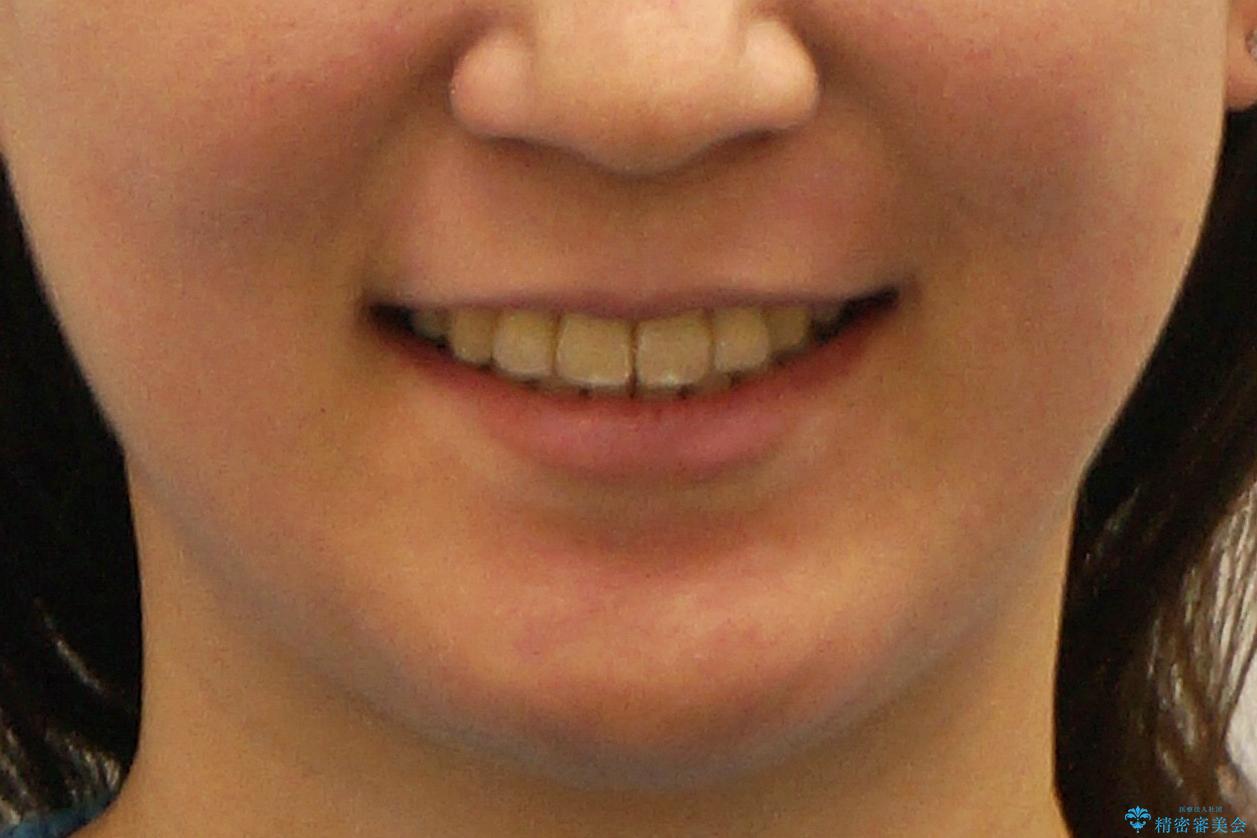 再矯正 一度抜かないでやったが、やっぱり抜いて口元下げたいの治療後(顔貌)