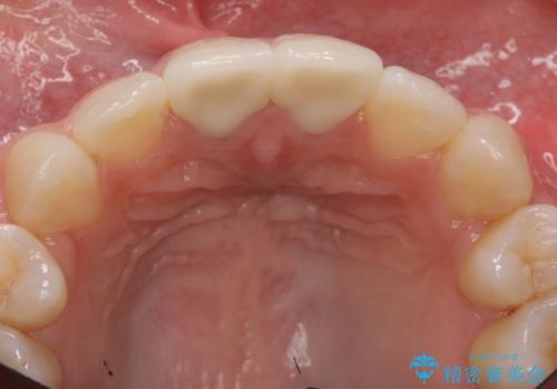 前歯の変色 セラミックで ホワイトニングも併用の治療後