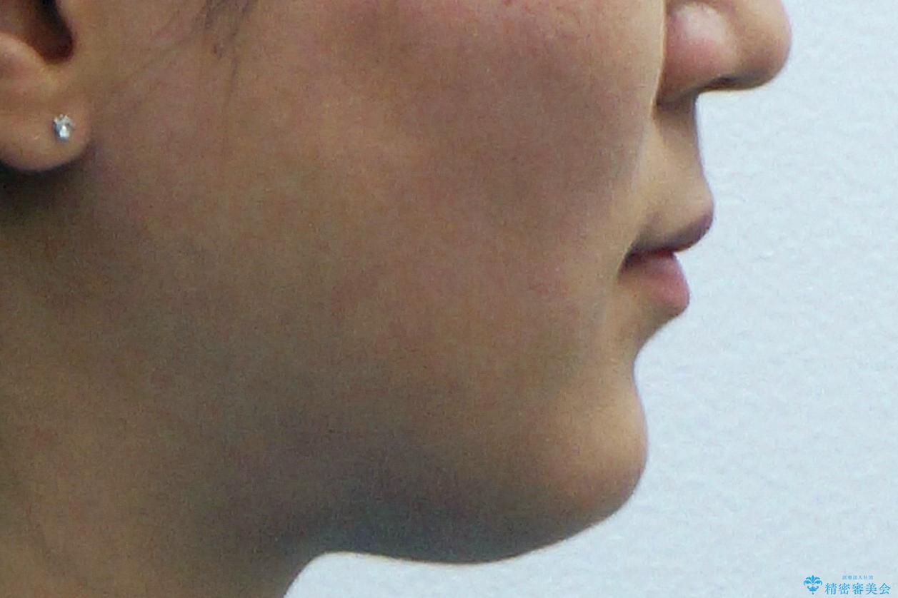 再矯正 一度抜かないでやったが、やっぱり抜いて口元下げたいの治療後(顔貌)