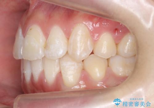 八重歯の治療 仕上がり重視での治療後