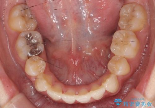 八重歯の治療 仕上がり重視での治療後