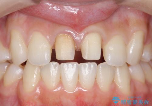 前歯の変色 セラミックで ホワイトニングも併用の治療中