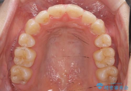 八重歯の治療 仕上がり重視での治療後