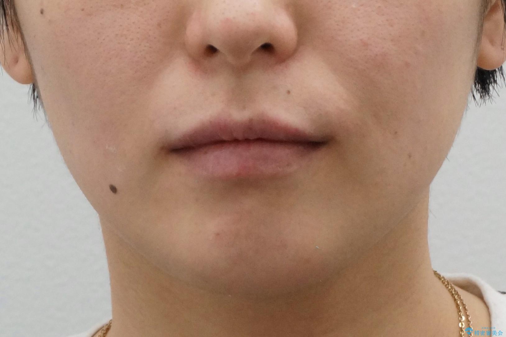 八重歯の治療 仕上がり重視での治療後(顔貌)