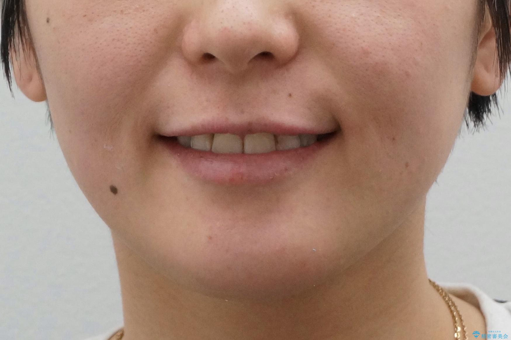 八重歯の治療 仕上がり重視での治療後(顔貌)