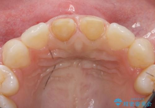 前歯の変色 セラミックで ホワイトニングも併用の治療中