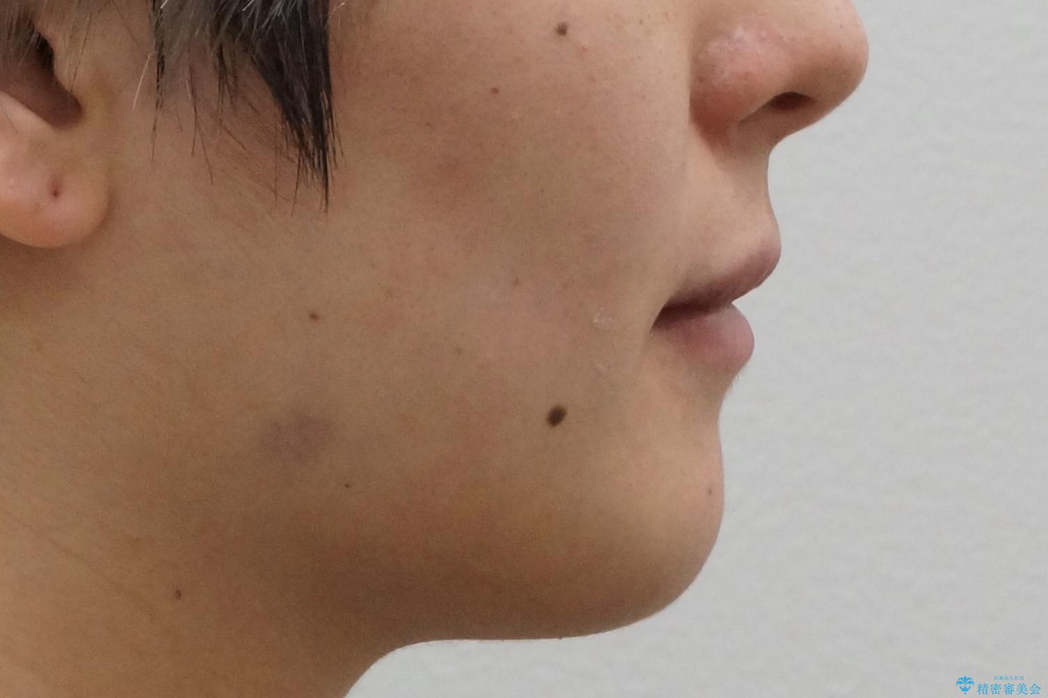 八重歯の治療 仕上がり重視での治療後(顔貌)