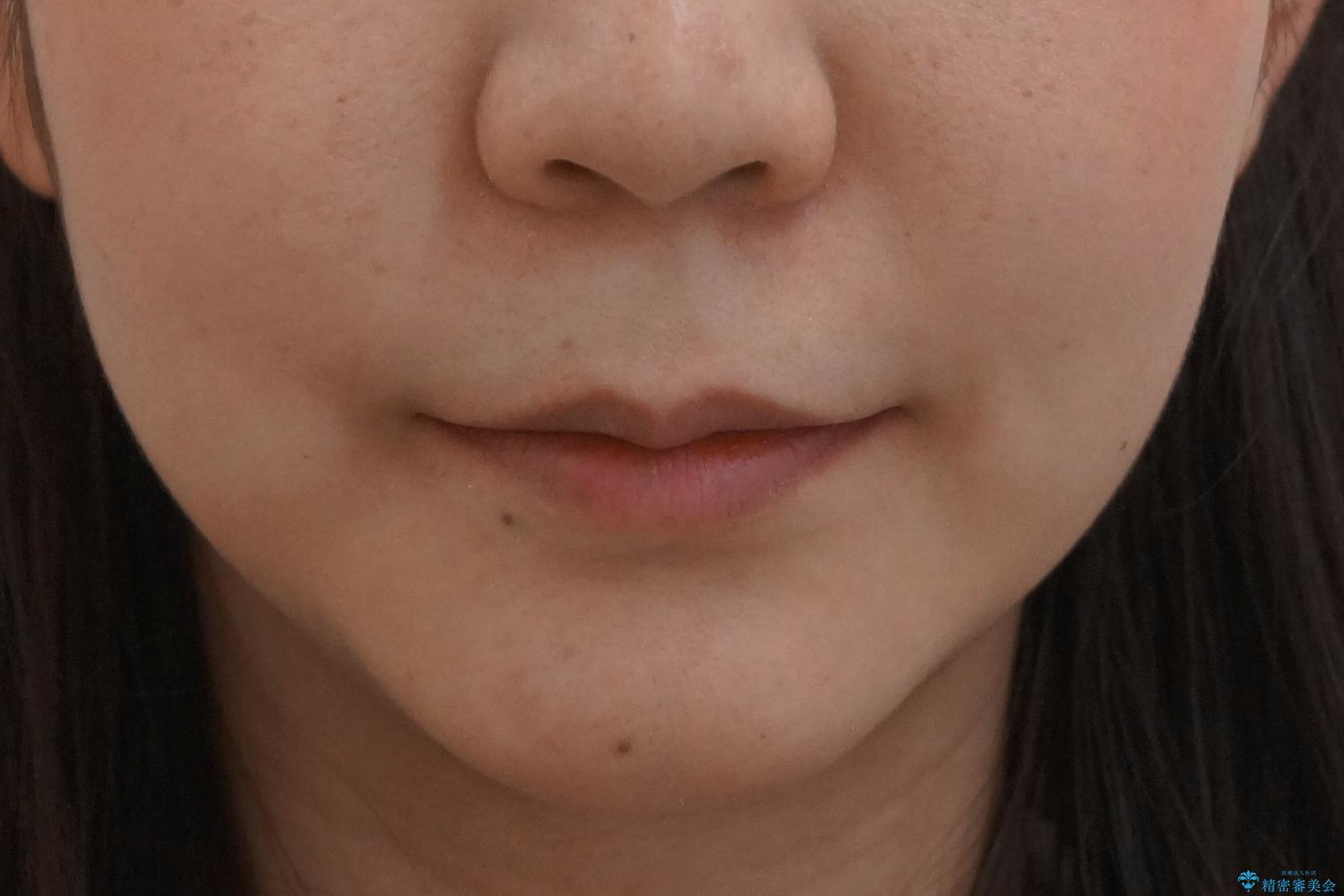 20代女性 口元を下げたい 前歯のがたつきの治療後(顔貌)