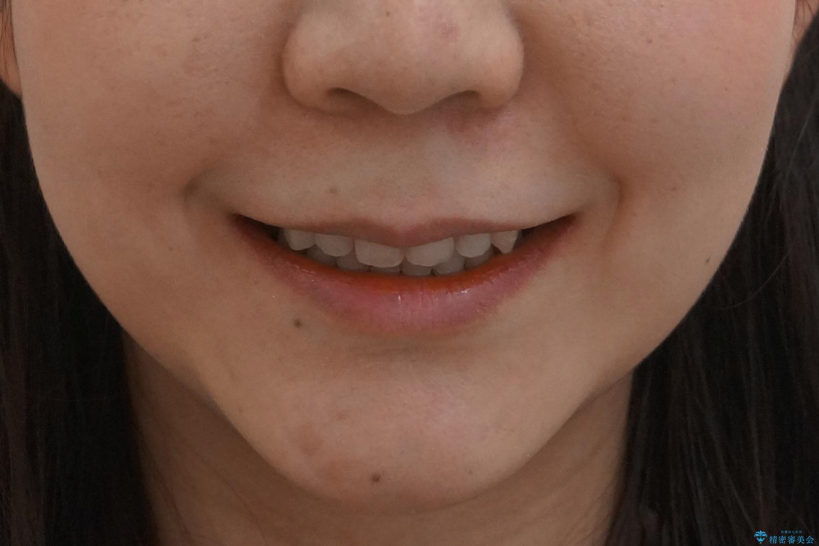 20代女性　口元を下げたい　前歯のがたつきの治療後（顔貌）