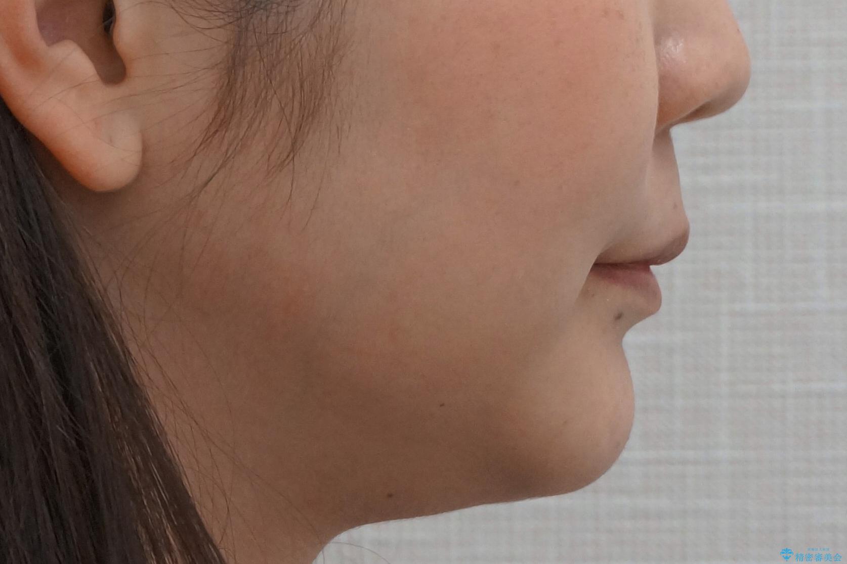 20代女性 口元を下げたい 前歯のがたつきの治療後(顔貌)