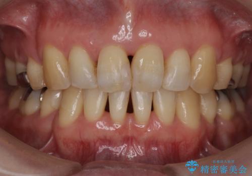 40代の矯正 出っ歯、歯のがたがたの症例 治療後