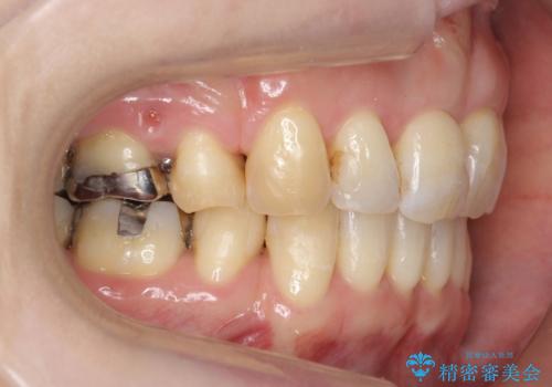 40代の矯正 出っ歯、歯のがたがたの治療後