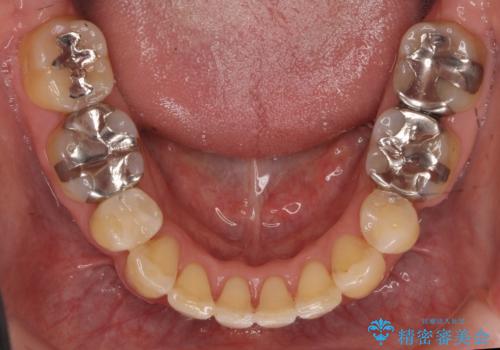 40代の矯正 出っ歯、歯のがたがたの治療後