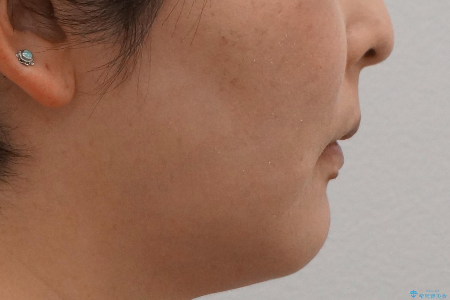 40代の矯正 出っ歯、歯のがたがたの治療後(顔貌)