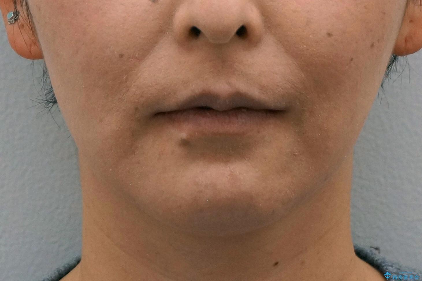 40代の矯正 出っ歯、歯のがたがたの治療後(顔貌)