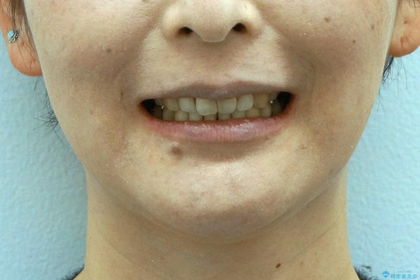 40代の矯正　出っ歯、歯のがたがたの治療後（顔貌）