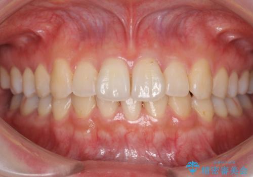 軽度の前歯のがたつき　下の前歯が生まれつき少ないの治療後
