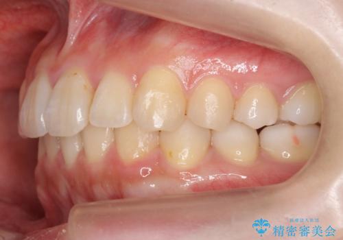 軽度の前歯のがたつき 下の前歯が生まれつき少ないの治療後