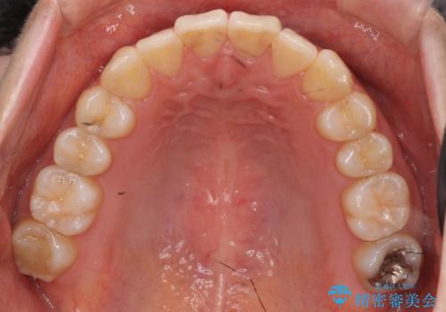 軽度の前歯のがたつき 下の前歯が生まれつき少ないの治療後