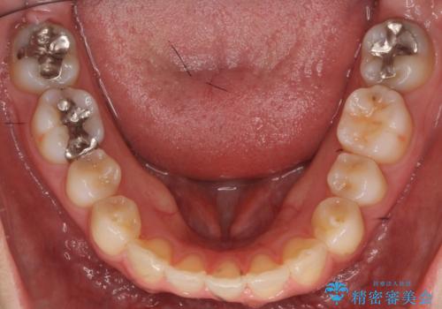 軽度の前歯のがたつき　下の前歯が生まれつき少ないの治療後