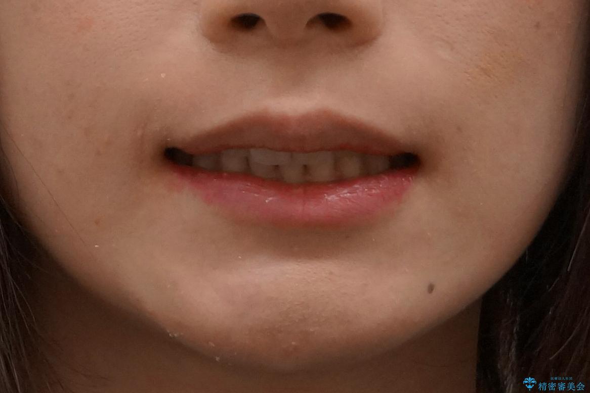 軽度の前歯のがたつき　下の前歯が生まれつき少ないの治療後（顔貌）