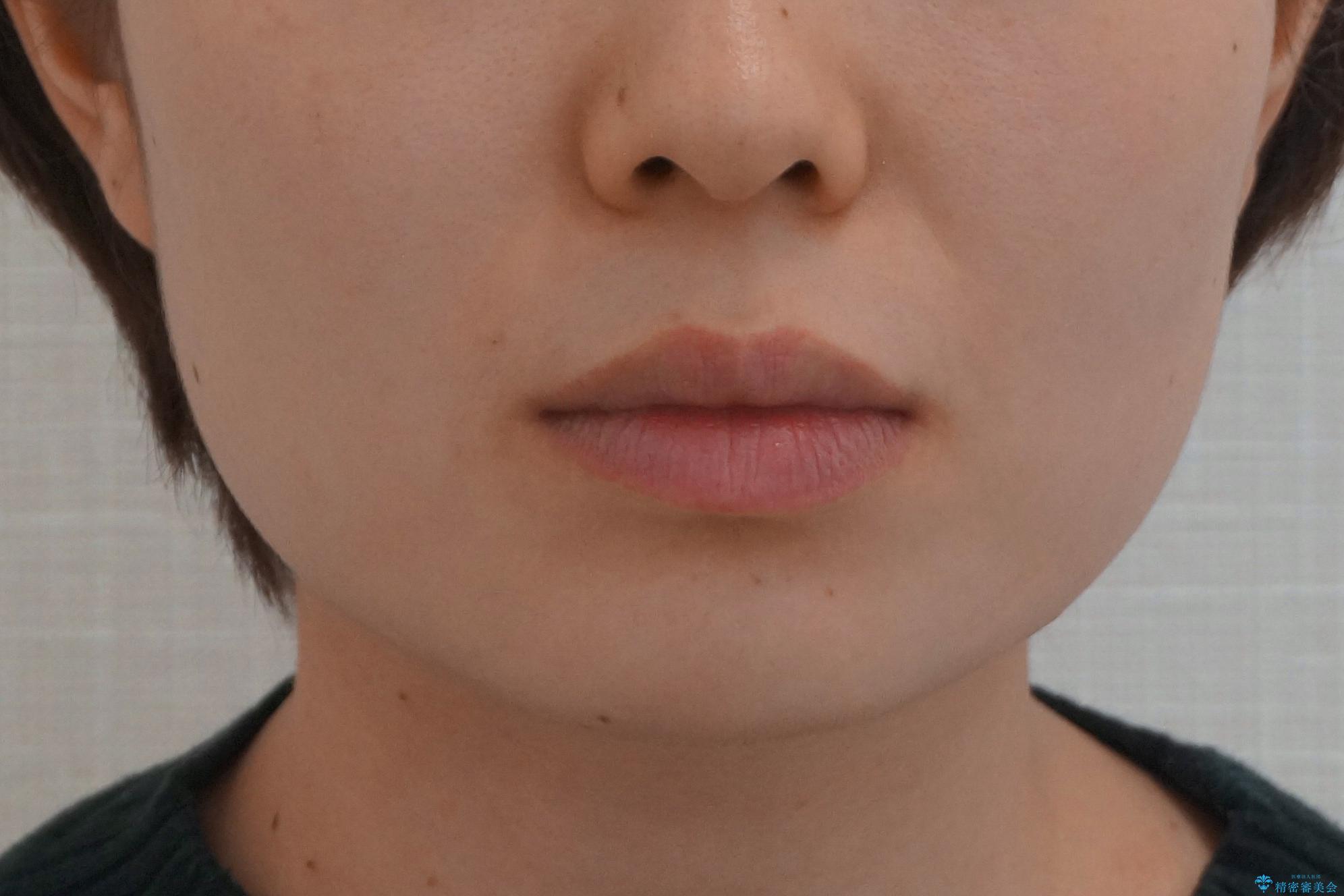 受け口の改善 歯を抜かずに矯正の治療後(顔貌)